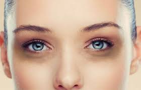 Gözaltı Morluğunuz için Tedavi mi Arıyorsunuz?