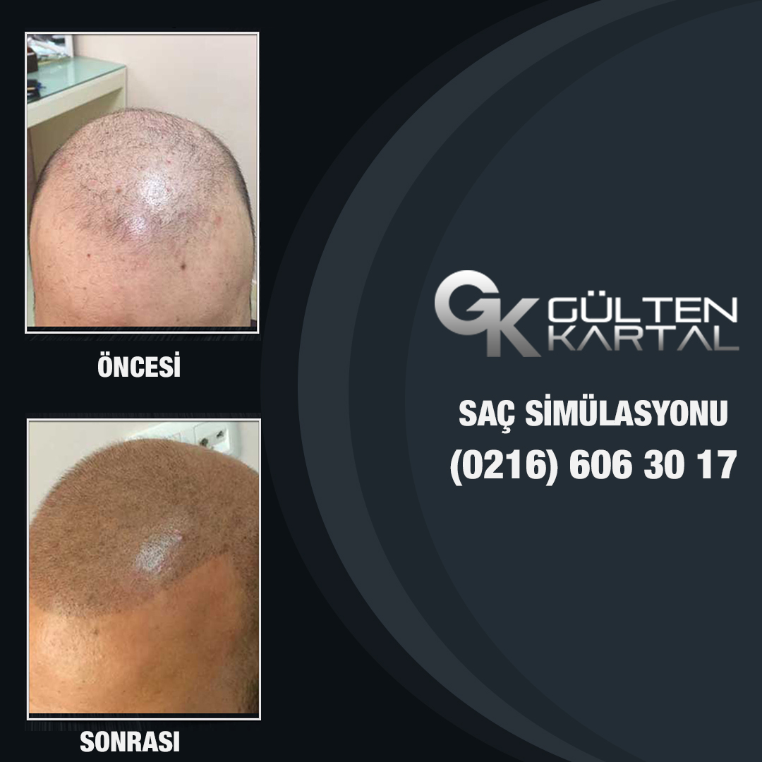 Saçsızlık, Kellik Kader Değil! İşte Saç Simülasyonu (Saç Gölgelendirme)!