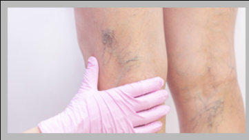 Ameliyatsız Varis Tedavisi Zehra Bayramoğlu