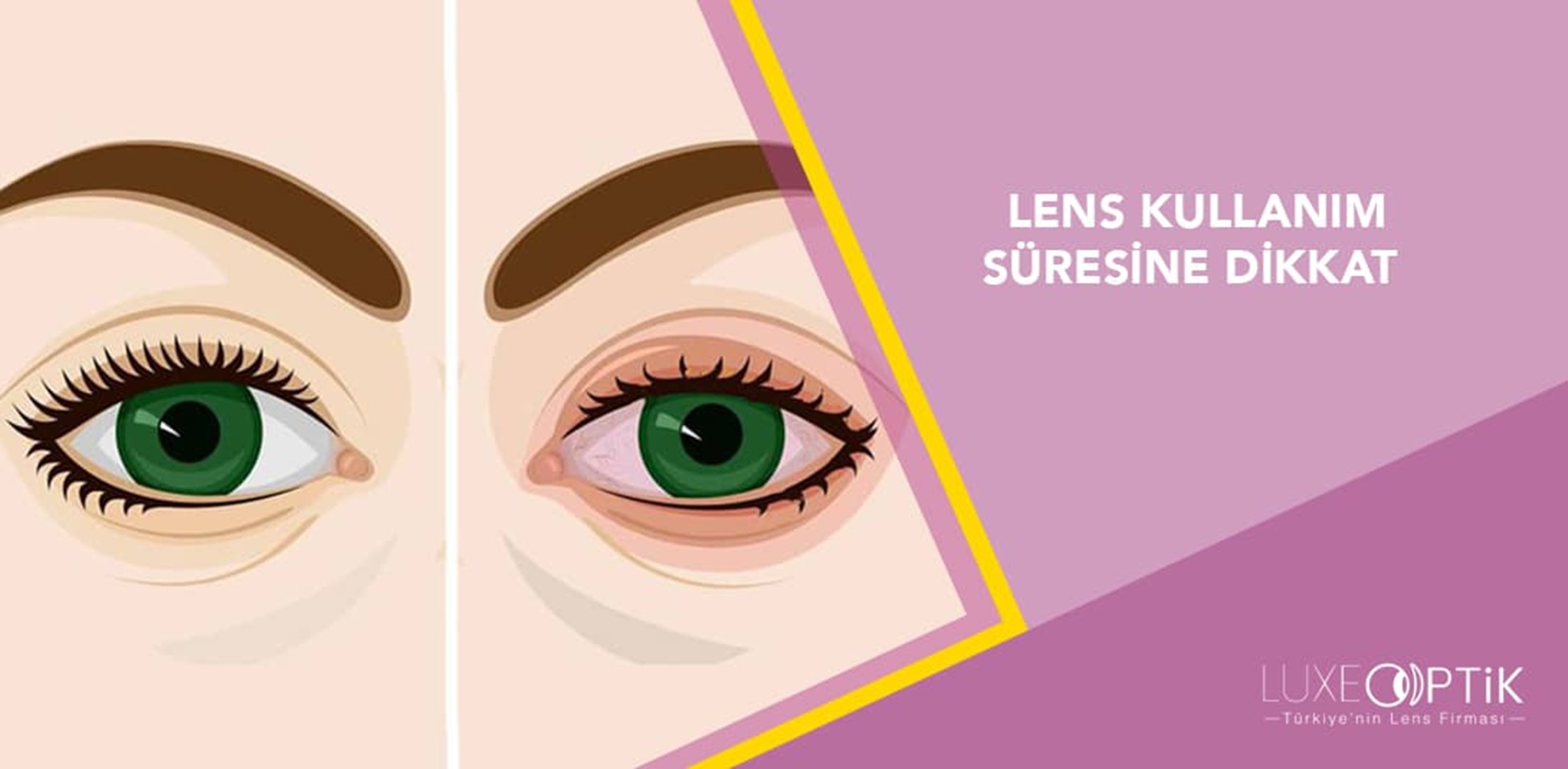 Lens Kullanım Süresine Dikkat