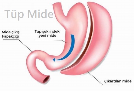 Tüp mide ameliyatı fiyatları 2024