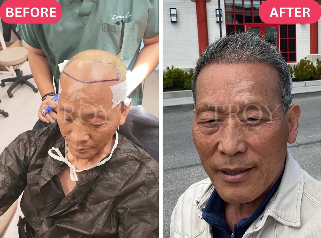 Best Hair Transplant in Turkey